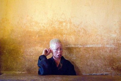 Albino's in Mali